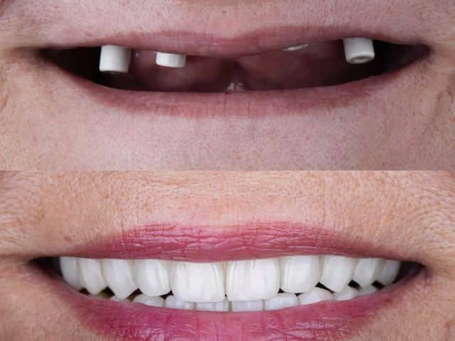 İmplant Tedavisi Sonrası Sizi Neler Bekliyor? Yeni Gülüş Rehberi