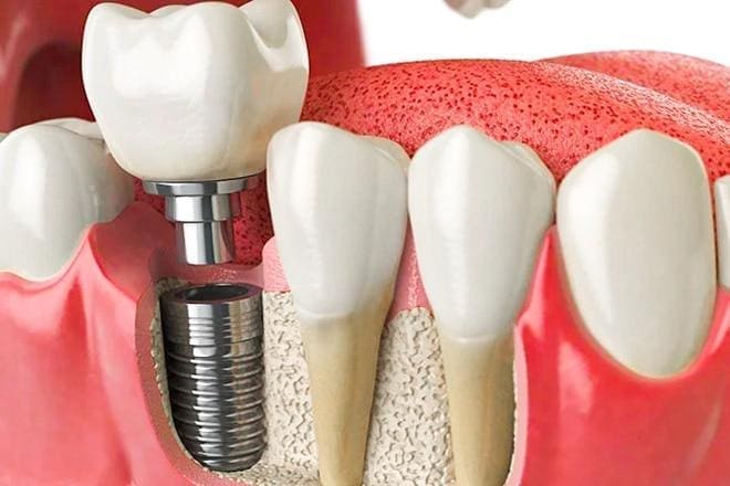 yalova implant