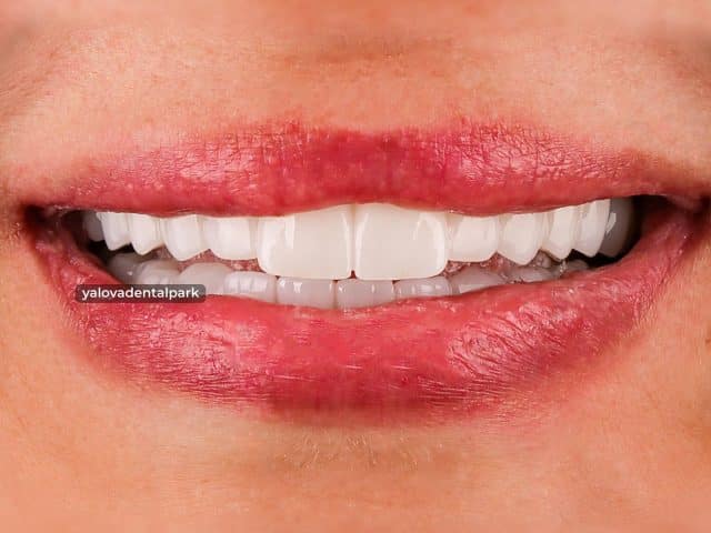 Yalova Gülüş Tasarımı ile Hayalinizdeki Gülüşe Kavuşun