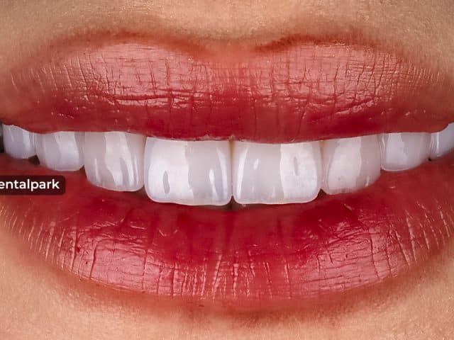 Yalova Diş Beyazlatma