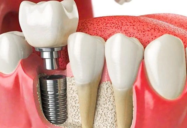 Yalova Diş İmplant