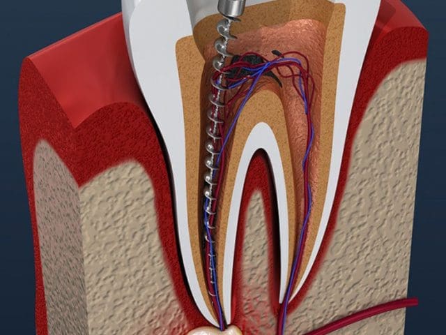 Yalova Kanal Tedavisi: Dişinizi Kaybetmeden Tedavi Edin